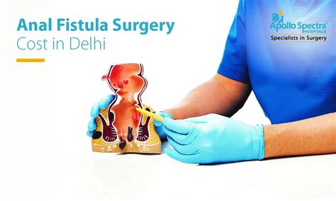 Anal Fistula Surgery Cost In Delhi Apollo Spectra
