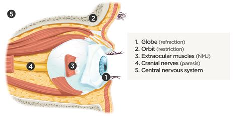 Diplopia Tags - Differential Diagnosis of