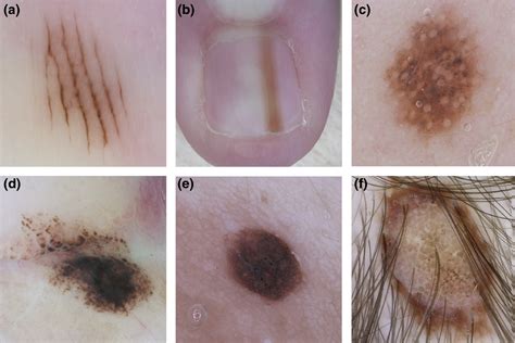 Abundance Of The Benign Melanocytic Universe Dermoscopic