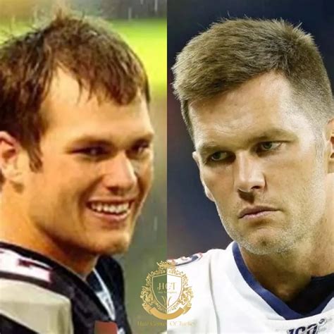Tom Brady Hair Transplant | Celebrities Hair Transplants - Hair Center ...