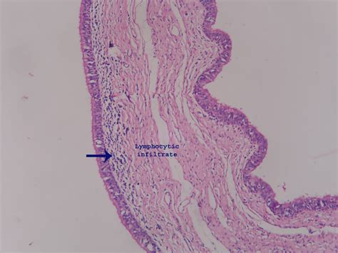 Branchial cleft cyst – Histopathology.guru