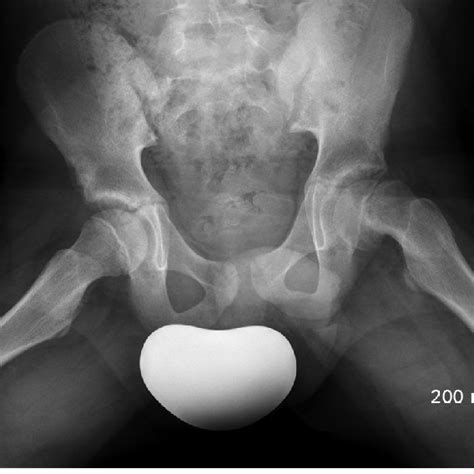 A A Anteroposterior And B Frog Leg Lateral Radiographs Showing