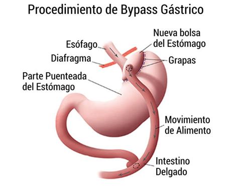 Bypass Gástrico Precio En Madrid Dr Jesús Lago