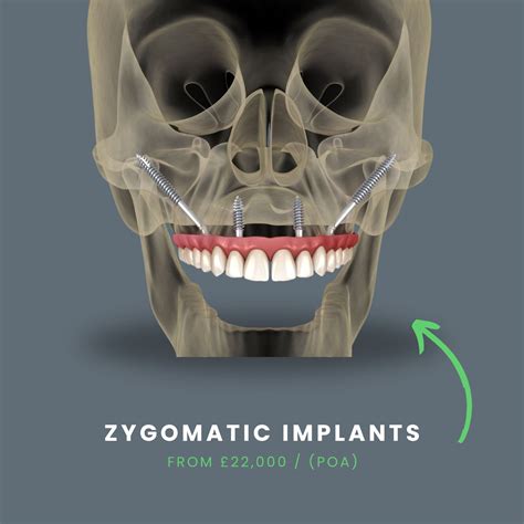 Zygomatic Implants 979 Success Rate Mint Dental Se1