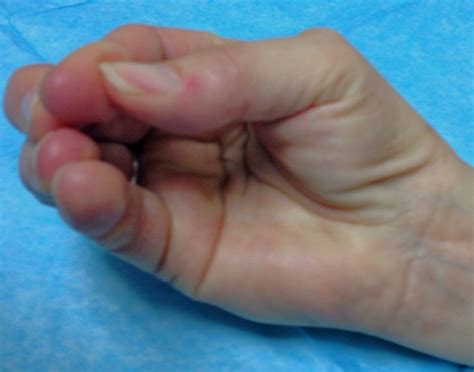 Thenar Muscle Atrophy | Hand Surgery Resource