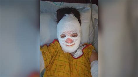 Woman Severely Burned By Pressure Cooker Device