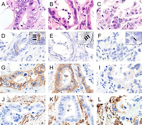 Lgr Expression At The Site Of Fat Invasion Representative Hematoxylin