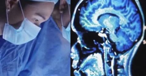 Vivo y retorciéndose médicos extraen un gigante gusano del cerebro