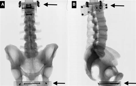 Anteroposterior A And Lateral B Biplanar Radiographs Of An Intact