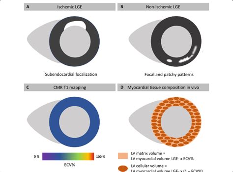 Cmr Based Myocardial Tissue Characterization A Cmr Derived Ischemic