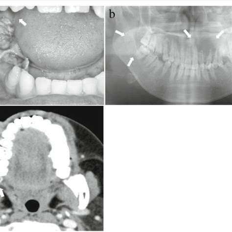 Diagnosis Of Case Photograph And Radiograph A Intraoral Photograph