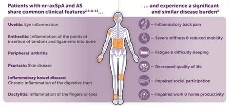 Spondyloarthritis – Symptoms, Causes and Treatment – Healthy Food Near Me