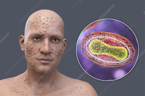 Smallpox Virus Infection Illustration Stock Image F