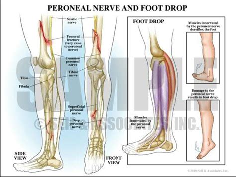 Peroneal Nerve Palsy With Foot Drop Youtube Hot Sex Picture