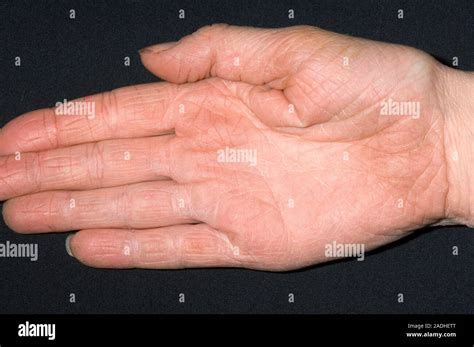 Model Released Eczema On A Patients Palm Eczema Is An Inflammation