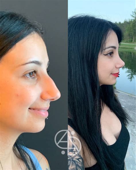 Rhinoplasty Result Dr Ahmet Dilber Rhinoplasty Rhinoplasty Before