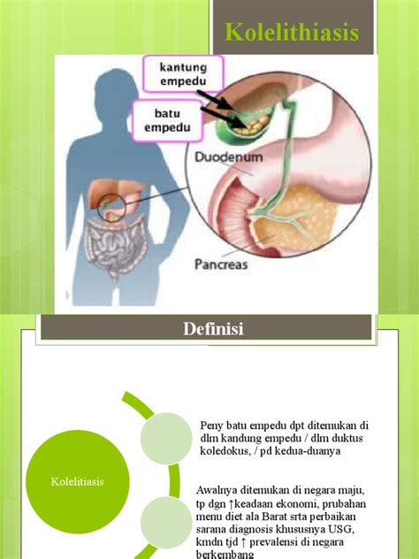 Panduan Lengkap Kolelitiasis dan Tatalaksana | PDF