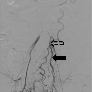 Bilateral Internal Iliac Angiography Showed Retrograde Blood Flow To