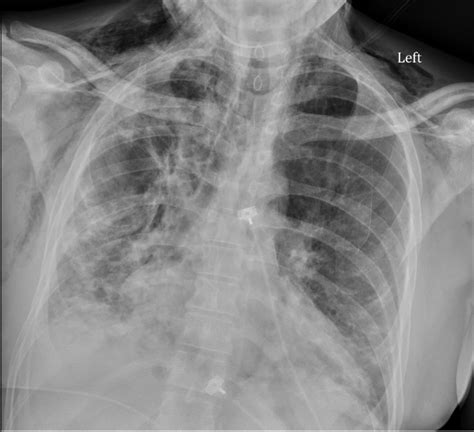 Dermatomyositis Chest