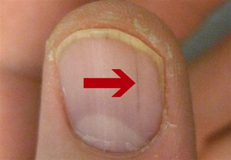 15 Health Warnings Your Fingernails May Be Sending