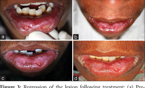 Figure 3 from Discoid lupus erythematosus at the vermilion border of the lip: A rare clinical ...