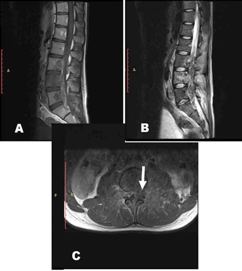 Resonancia Magn Tica De Columna Lumbosacra A Y B Observe Las