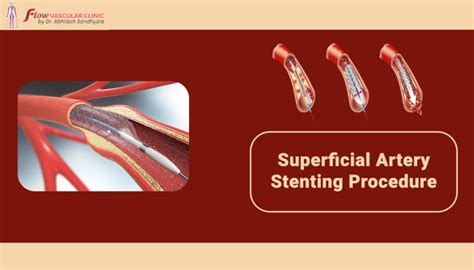 Superficial Artery Stenting Procedure Dr Abhilash