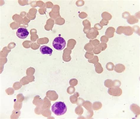 Peripheral Blood Smear Showing Presence Of Hypolobulated Neutrophils