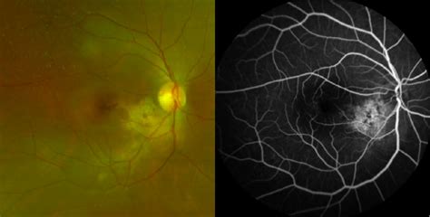 Multiple Dynamic Oct Octa Views Of Choroidal Osteoma Co Towardpi