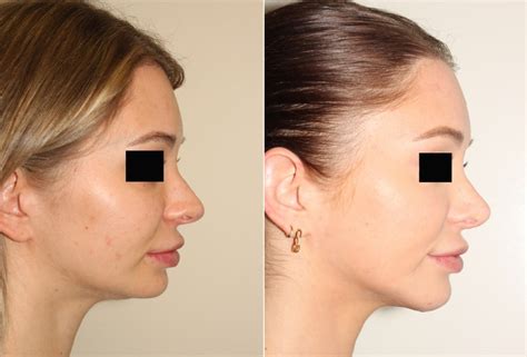 Rhinoplasty And Chin Augmentation Dr Denton