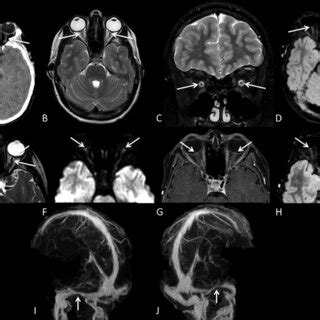 Computed Tomography CT Without Contrast Revealing Cerebrospinal