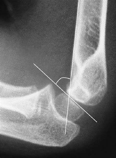 lateral capitellohumeral angle figure  baumann angle