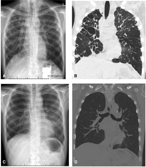 Radiographic Imaging Pre And Post Transplant A Chest Radiograph At