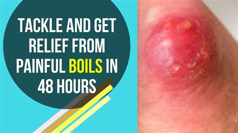 Tackle And Get Relief From Painful Boils In 48 Hours Youtube