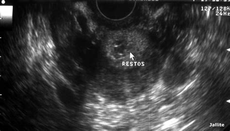 Cuerpo Luteo Hemorragico