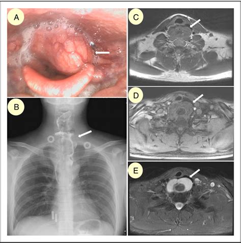 Figure 3 From Diagnosis And Management Of Giant Esophageal