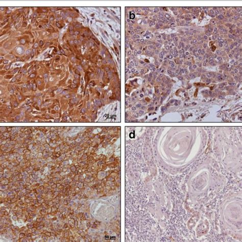 Immunohistochemical Expression Of Moesin In Oral Squamous Cell