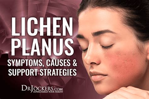 Lichen Planus Symptoms Causes Support Strategies Artofit