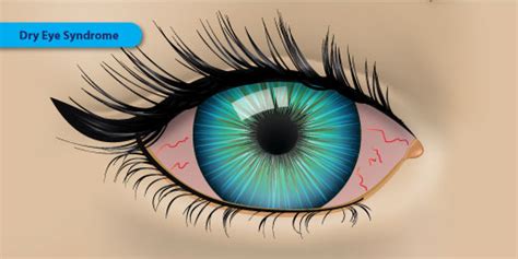 Dry Eye Syndrome - Symptoms, Causes and Treatment | FYEyes