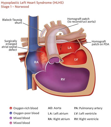 Fontan procedure, uses, types, recovery & complications
