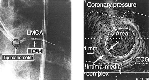 Assessment Of Coronary Artery Distensibility By Intravascular