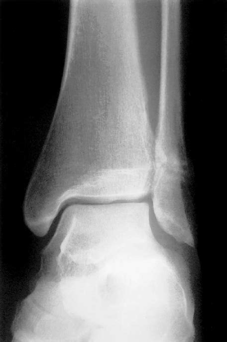 Avulsion Fracture Of Distal Fibula