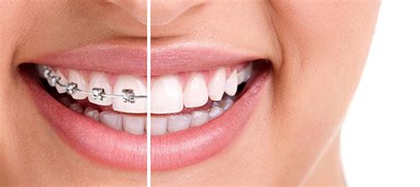 Traditional Braces Vs Clear Aligners All You Need To Know