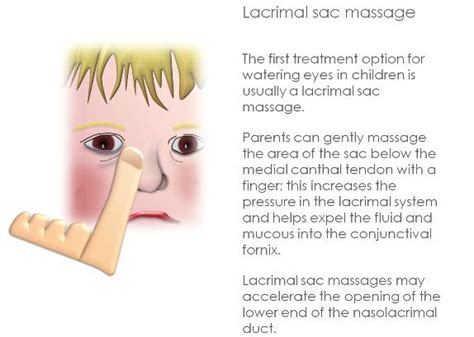 Lacrimal Sac Massage Technique Blocked Tear Duct Blocked Tear Duct