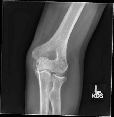 Radial Neck Fracture Radiology Case Radiopaedia Org