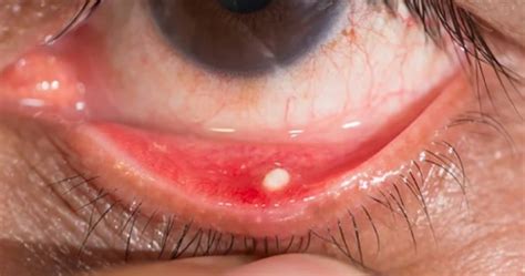Insight Into Conjunctival Concretion Causes Symptoms And Solutions