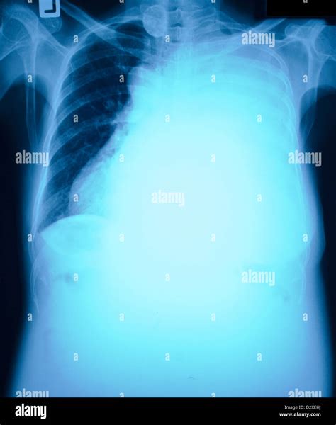 Pneumonia Patients X Ray Film Stock Photo Alamy