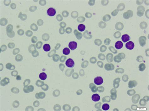 Lymphoma Peripheral Blood Smear