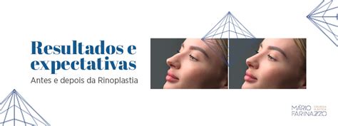 Tudo que você precisa saber sobre rinoplastia Dr Mário Farinazzo