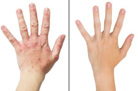 Eczema Treatments Available From Dermatologist Dr Gergana Gallacher